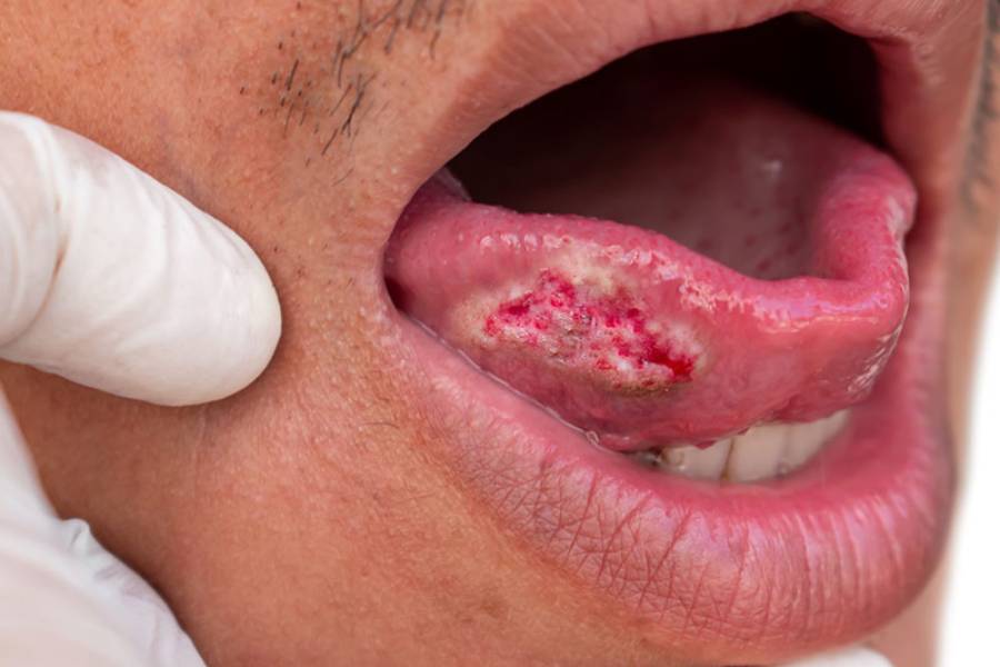 Oral cancer treatment in Pune - Dr. Pratik Patil