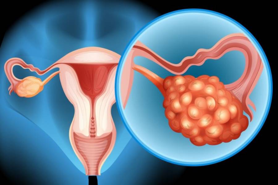 Ovarian Cancer Treatment in Pune -Dr. Pratik Patil