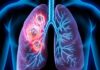 9 Early Warning Signs of Non-Small Cell Lung Cancer | Dr. Pratik Patil