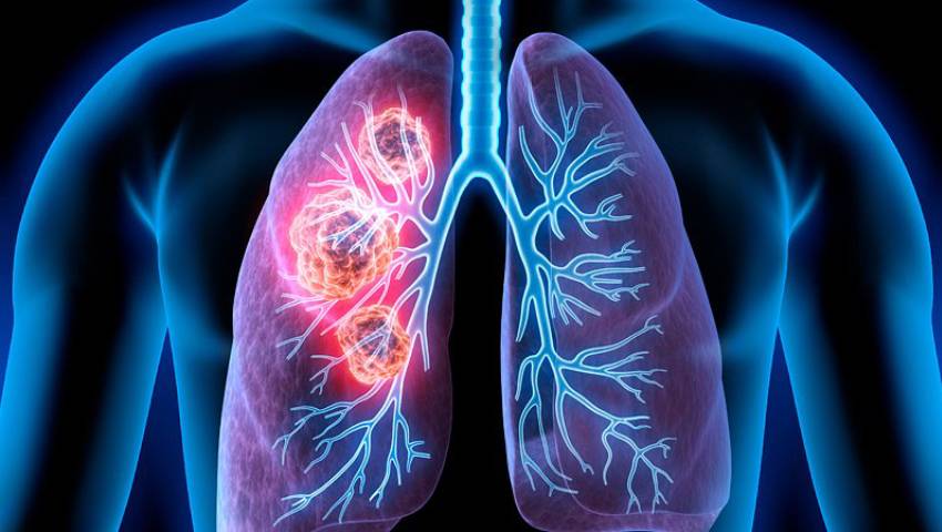 9 Early Warning Signs of Non-Small Cell Lung Cancer | Dr. Pratik Patil