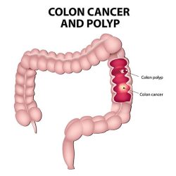 Colon cancer and polyp detection by Dr. Pratik Patil, leading colon cancer treatment specialist in Pune.